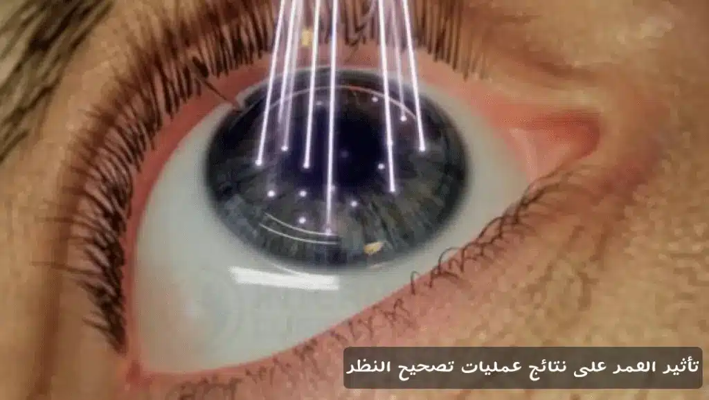 تأثير العمر على نتائج عمليات تصحيح النظر