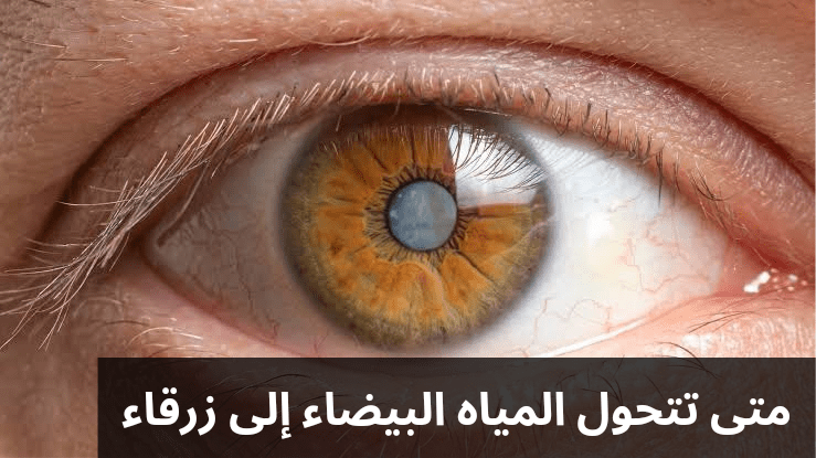متى تتحول المياه البيضاء إلى زرقاء